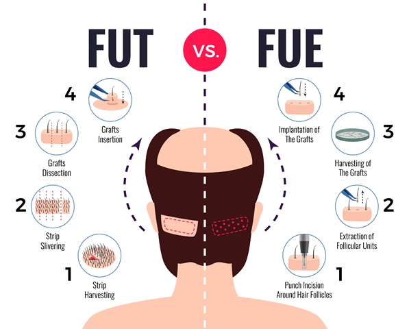 Comparing FUE, FUT, and DHI Hair Transplant Techniques: Which Is Best for You?