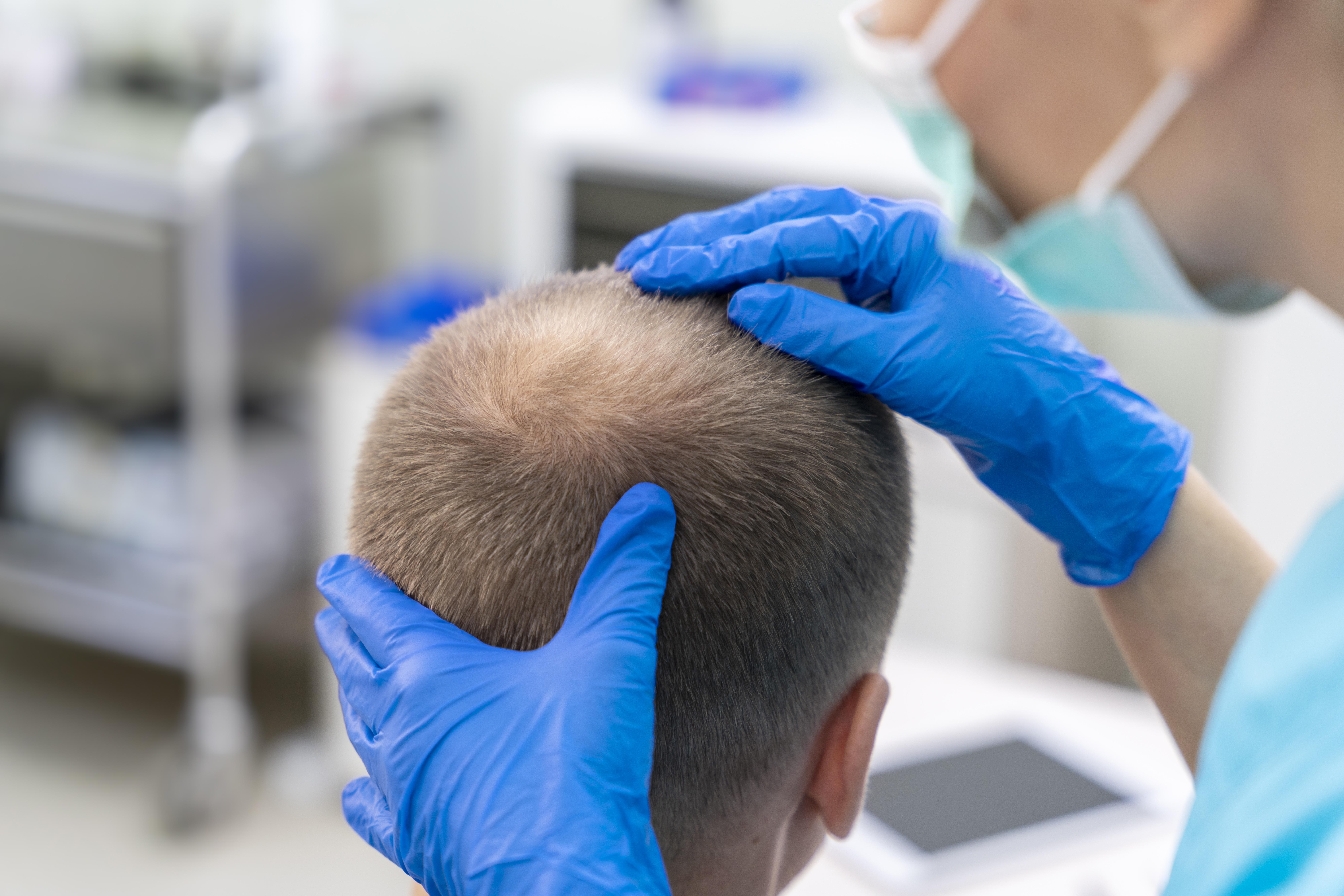 FUT Hair Transplant: Technique, Benefits, Risks, and What to Expect