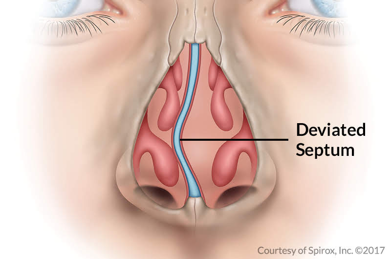 deviated septum rhinoplasty