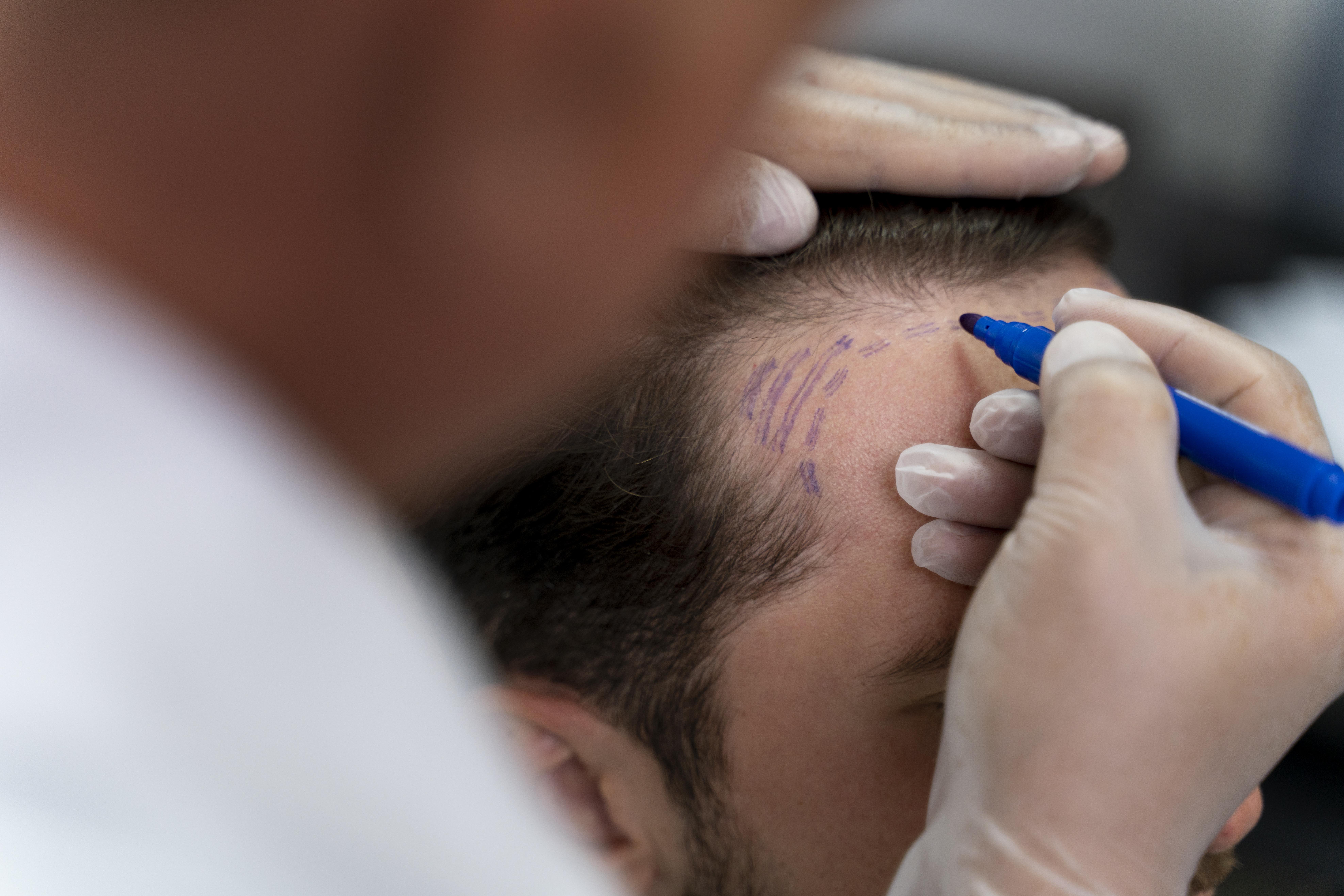 hair transplant doctor and patient
